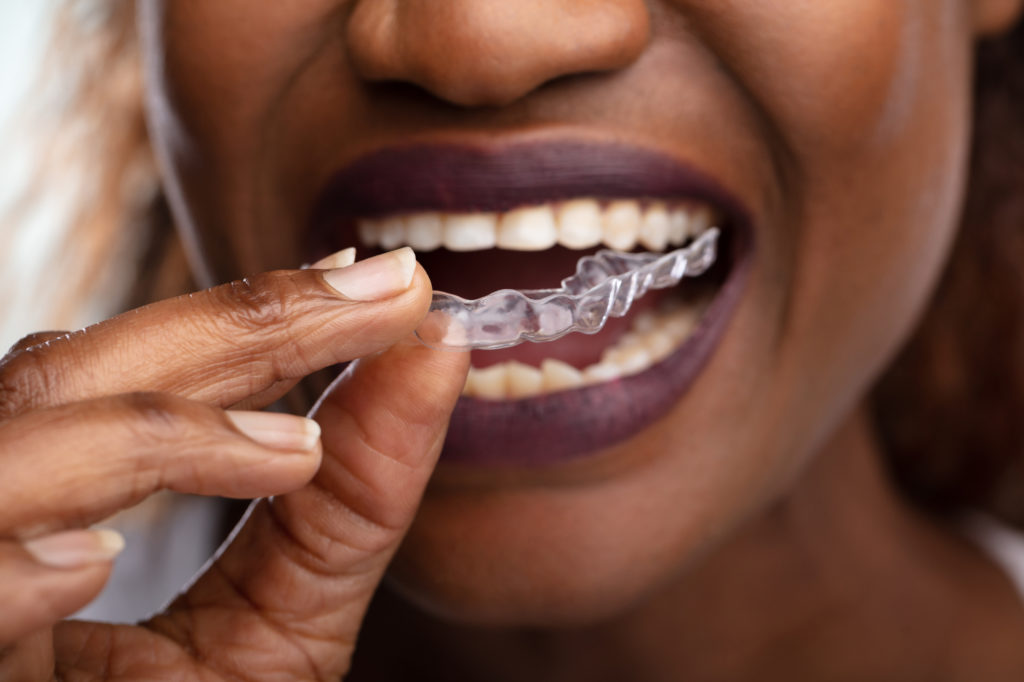woman putting her Invisalign clear aligners in her mouth